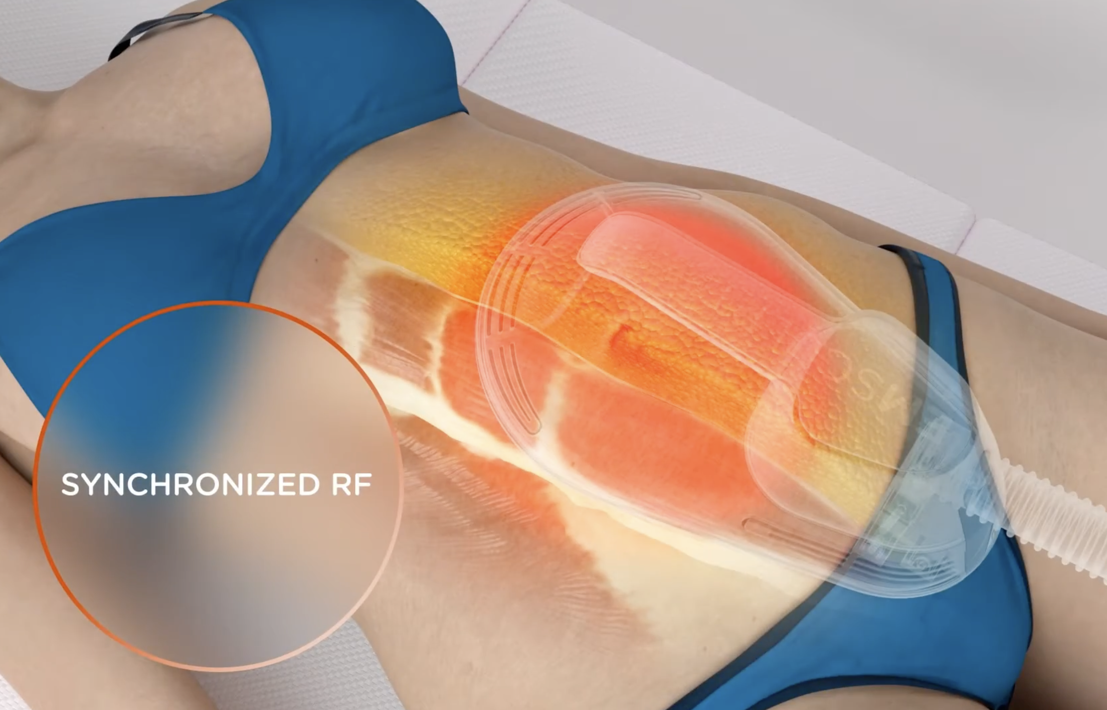 EMSculpt postparto y diástasis abdominal